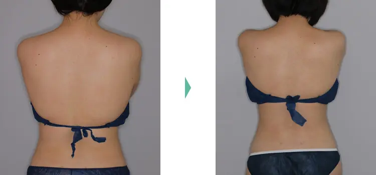 ライポソニック 痩身 機械 ボディ ダイエット サロン ライポソニックス