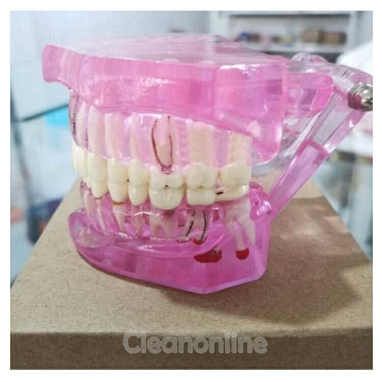 透明歯牙疾患模型