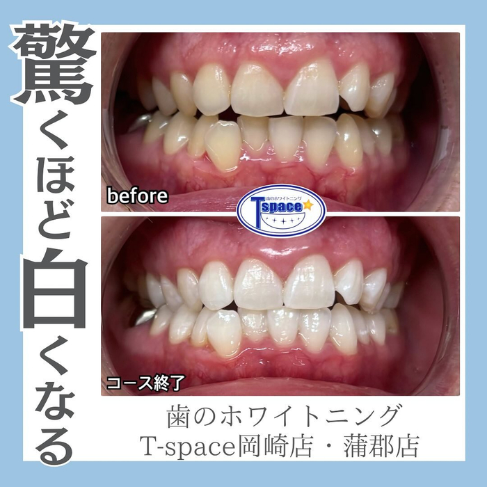 驚くほど白くなる！】 | Instagram | 愛知県岡崎市のセルフ
