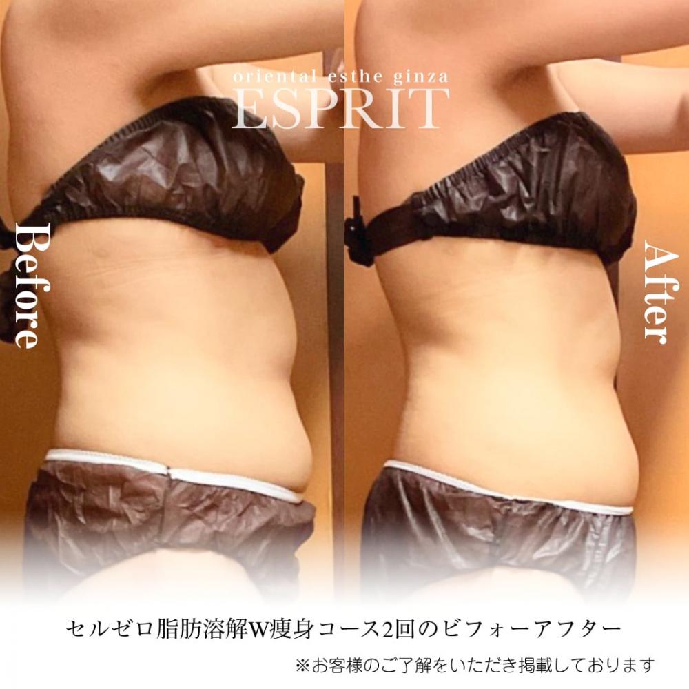 ダイエット】セルライト 脂肪消滅 超音波 脂肪消滅 痩身 セルライト