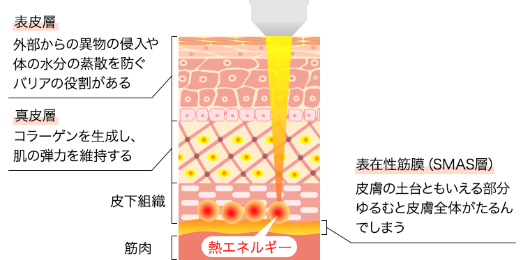 高密度焦点式超音波リフト（HIFU）でたるみ治療｜東京・銀座肌クリニック