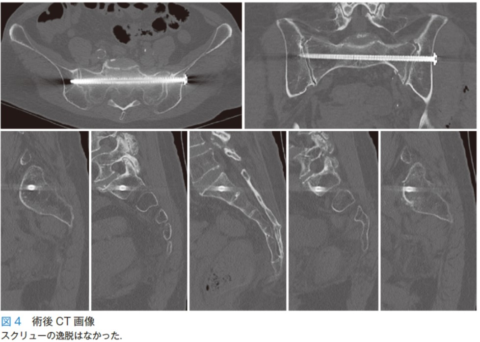 医学界新聞プラス ［第4回］脆弱性骨盤骨折 | 2024年 | 医学界新聞
