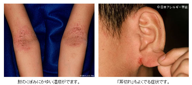 アトピー性皮膚炎／Q＆A｜一般社団法人日本アレルギー学会