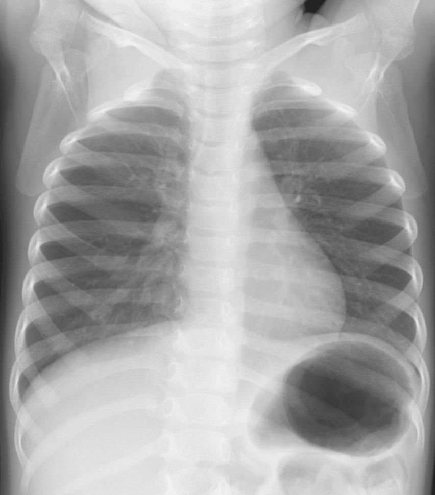 読影の実際｜胸部写真の読み方｜太田東こども＆おとな診療所｜こどもと