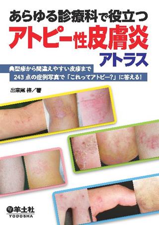 アトピー性皮膚炎はこわくない アトピー性皮膚炎はこわくない (三一