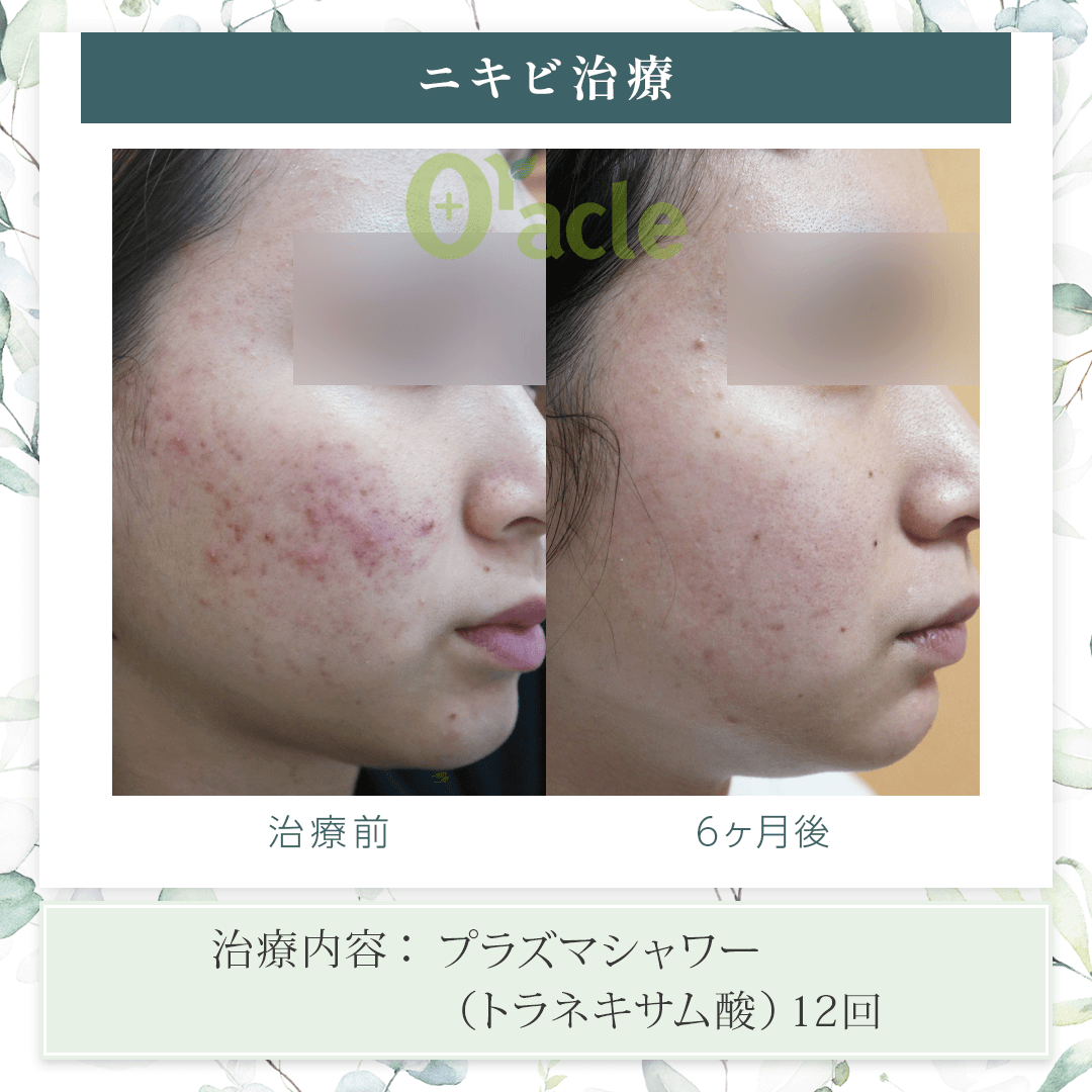 プラズマシャワープラズマフェイシャル