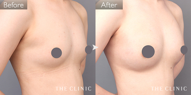 ビブラ BEbra the clinic 豊胸 バストアップ