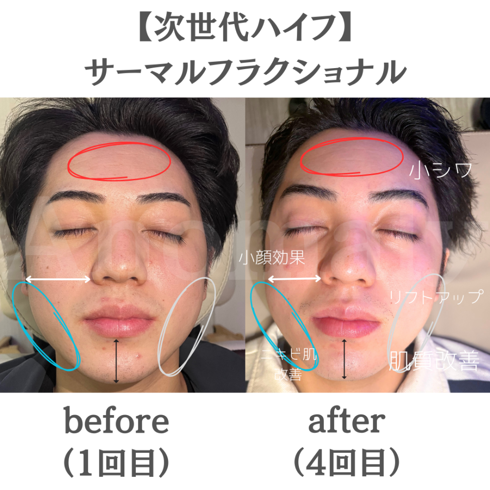 次世代ハイフ】サーマルフラクショナルがヤバい - Anomaly 六本松店 ブログ