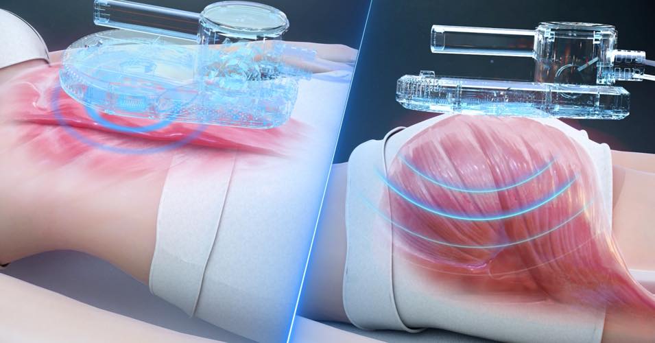 エステの最新電磁パルスマシン「マグスリム」
