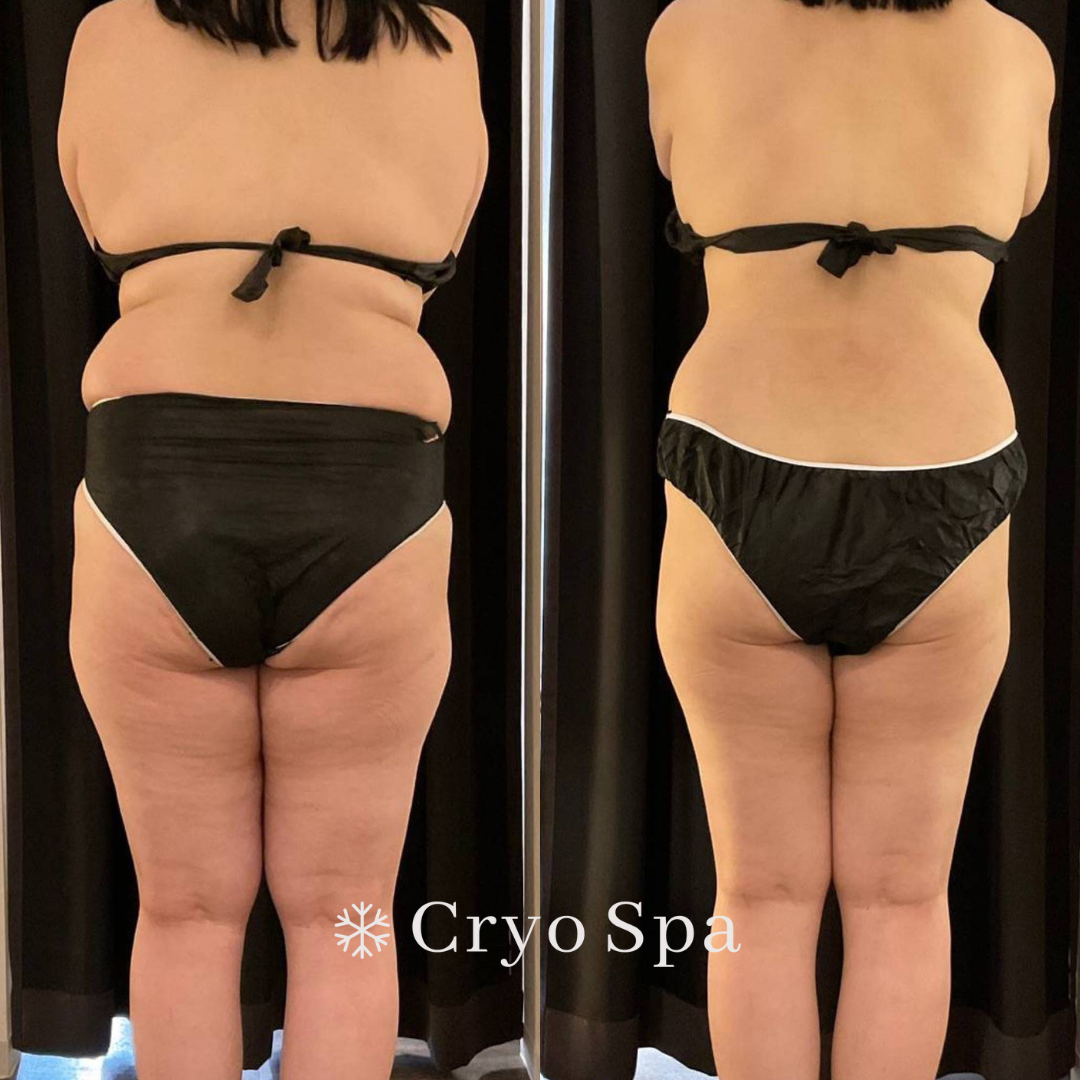 施術例 | 脂肪冷却痩身専門店 Cryo Spa（クリオスパ）