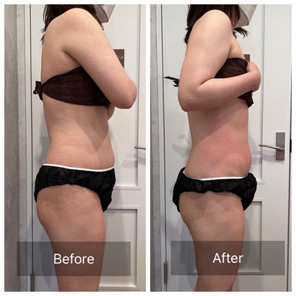 最新美容機器！】ハイパーナイフ、キャビ、EMS、吸引、ニキビ治療など