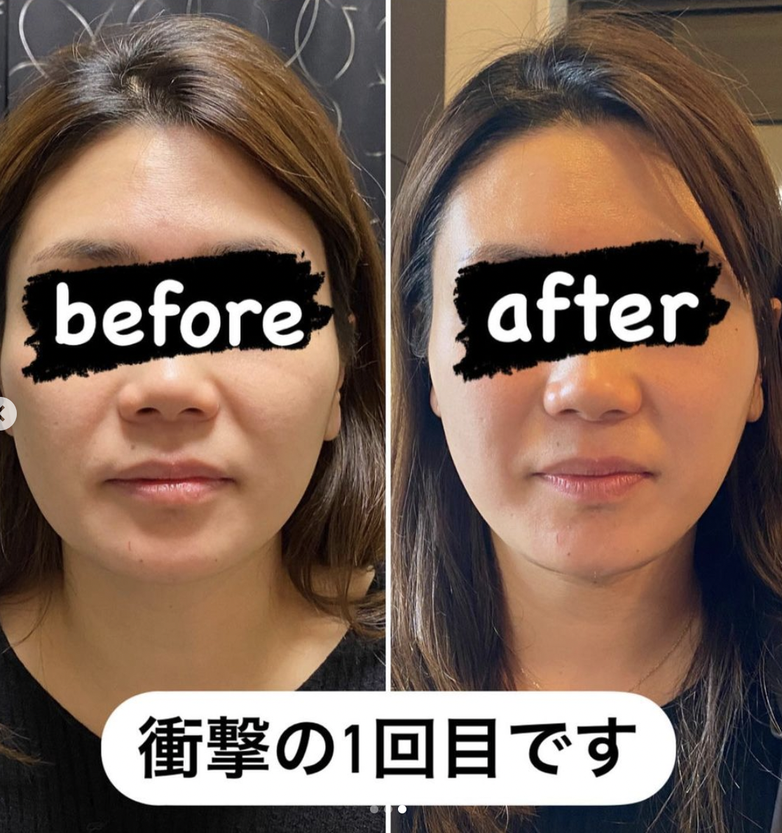 フォーカスネオ‼️ヘッド3種類 30万円相当付‼️ フォーカスネオ‼️Dr