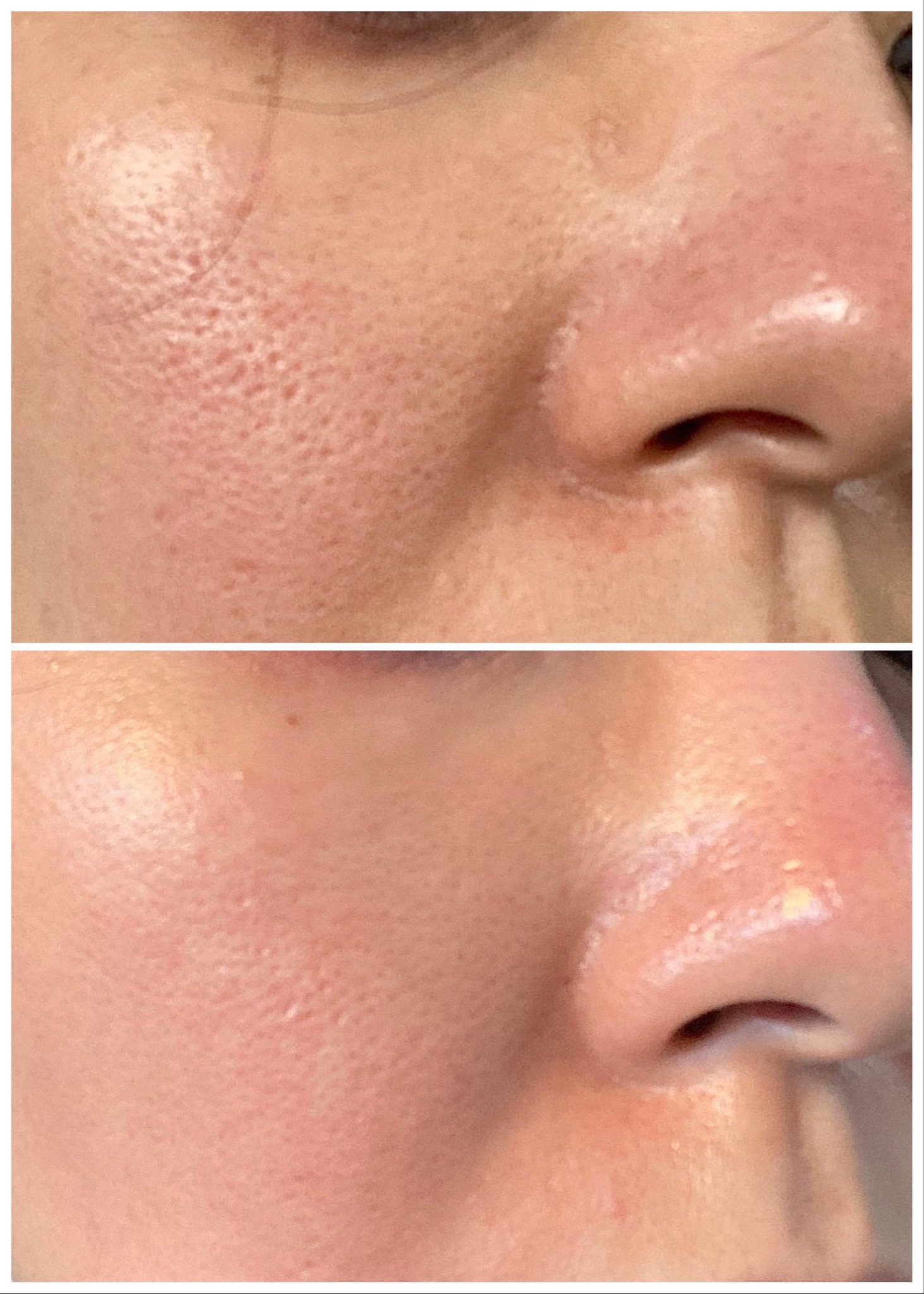 トリア・スキンエイジングケアレーザー