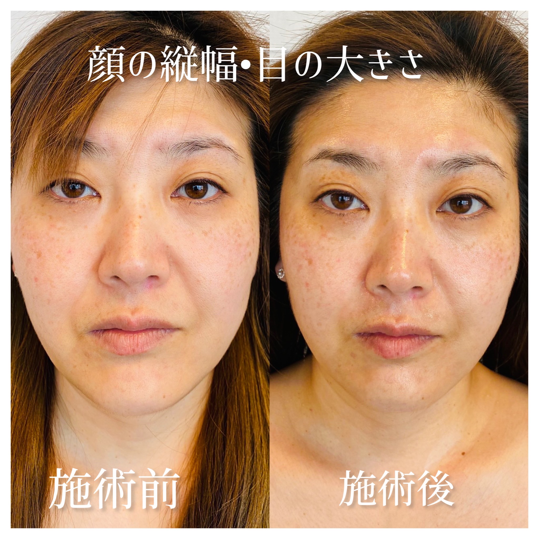 プラズマシャワープラズマフェイシャル