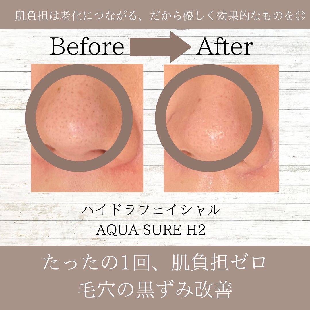正規品！ハイドラフェイシャル保険加入水素角質毛穴必須メニュー