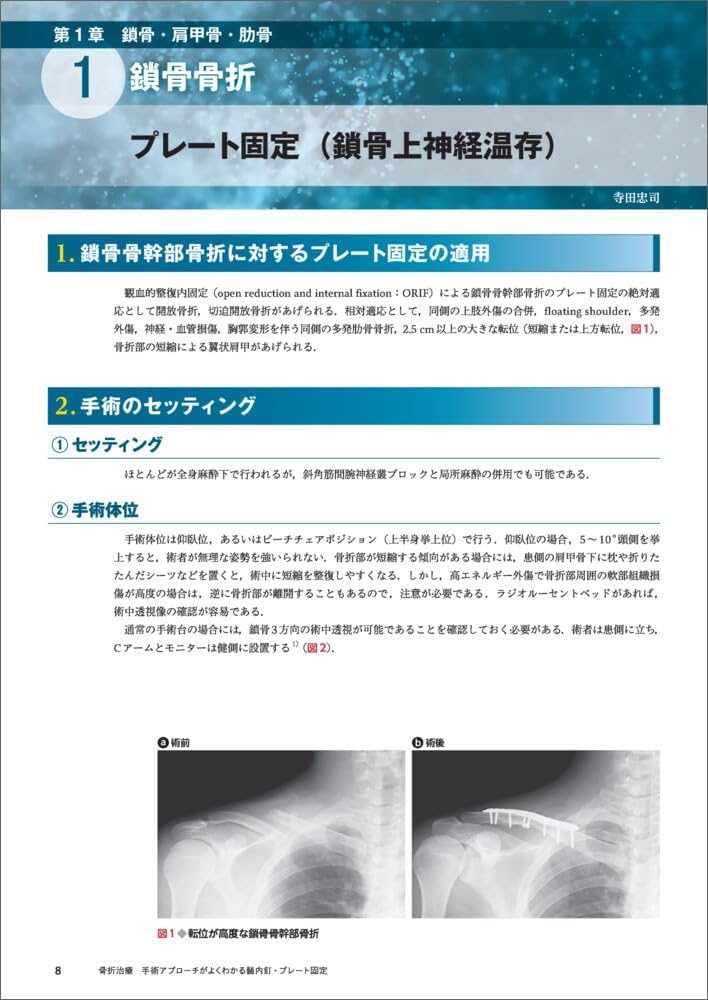 骨折様 VP9 大腿骨頚部適応インプラント｜製品情報｜株式会社 ホムズ