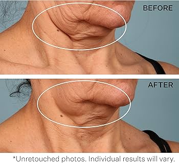 Amazon | クラインベッカー (ストリベクチン) - StriVectin-TL