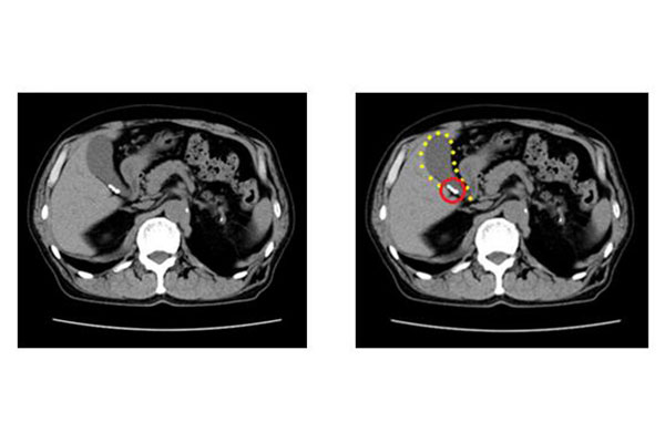 胆嚢(たんのう)に石があると言われたら～胆石症について～ | みどり