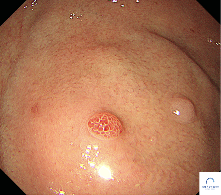 今月の1例：胃底腺ポリープとラズベリー様腺窩上皮型胃腫瘍｜みゆき