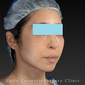 サーマクールFLX(切らないたるみ治療) | 新宿ラクル美容外科クリニック