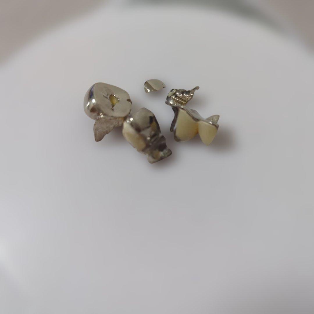 m*o様 銀歯/被せ物