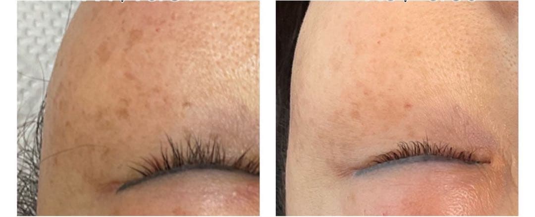 低周波ペンシル シミケア機 リシルク ReSilk セット販売 - メルカリ